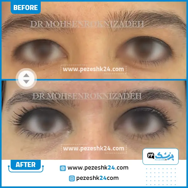 قبل و بعد از جراحی بلفاروپلاستی دکتر رکنی زاده