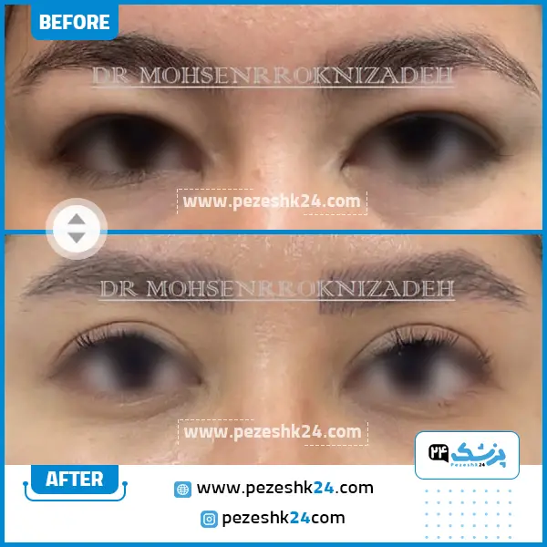 قبل و بعد از جراحی بلفاروپلاستی دکتر رکنی زاده مشهد