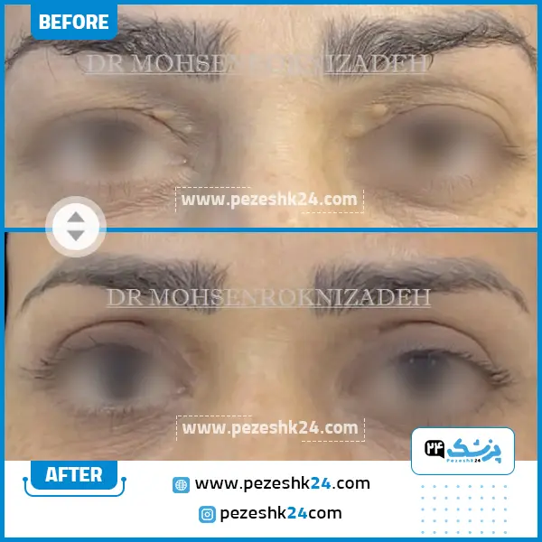 قبل و بعد از بلفاروپلاستی دکتر رکنی زاده