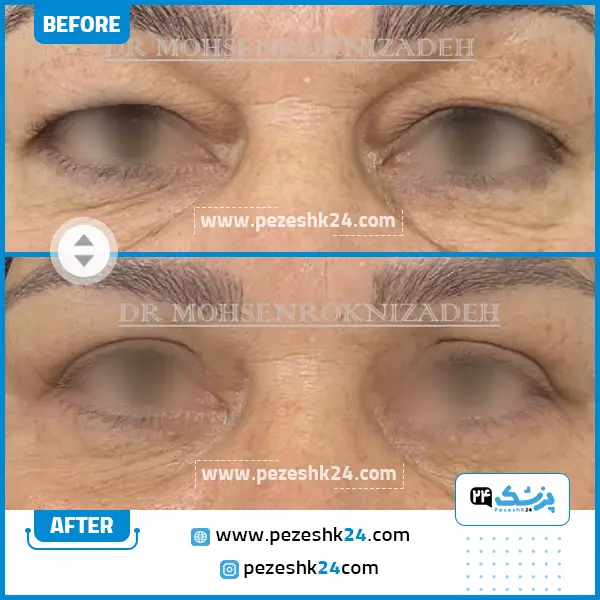 قبل و بعد بلفاروپلاستی دکتر رکنی زاده