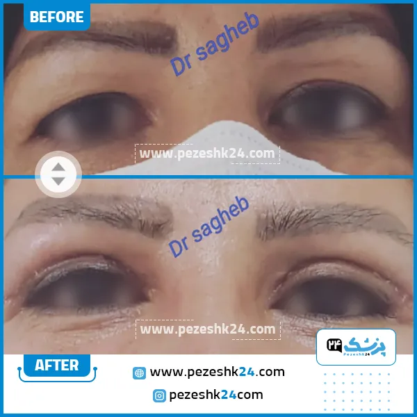 قبل و بعد جراحی بلفاروپلاستی دکتر ثاقب