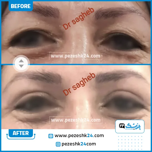 قبل و بعد جراحی بلفاروپلاستی دکتر ثاقب مشهد