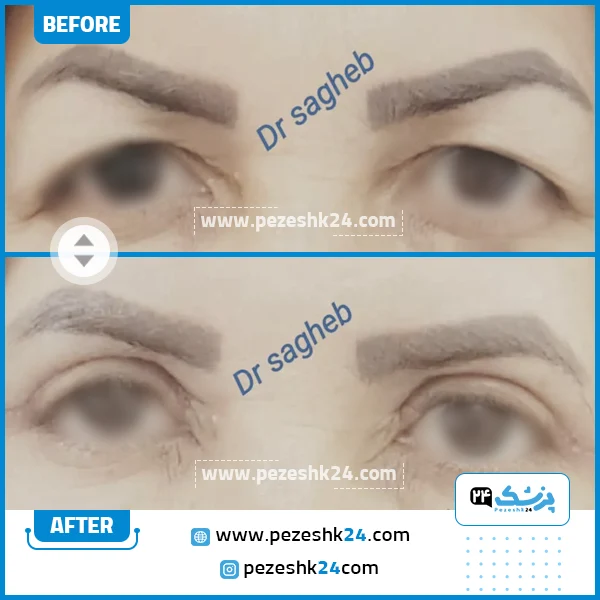 قبل و بعد جراحی بلفاروپلاستی دکتر ستاره ثاقب