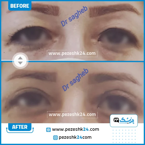 قبل و بعد بلفاروپلاستی دکتر ثاقب