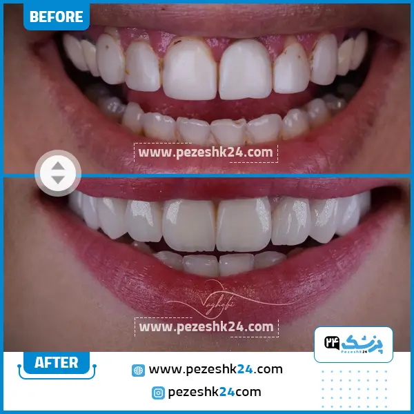 قبل و بعد کامپوزیت دندان دکتر واقفی تهران