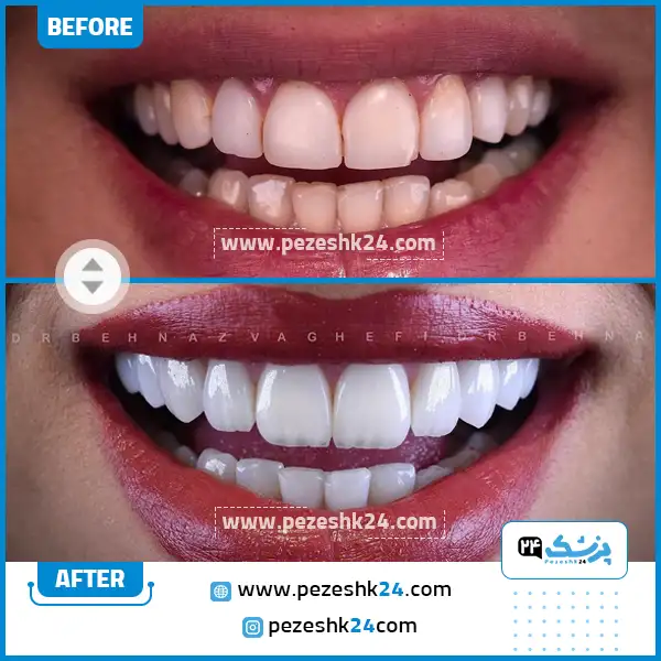قبل و بعد از کامپوزیت دکتر واقفی