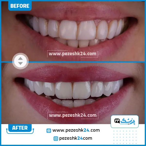 قبل و بعد از کامپوزیت دندان دکتر واقفی تهران