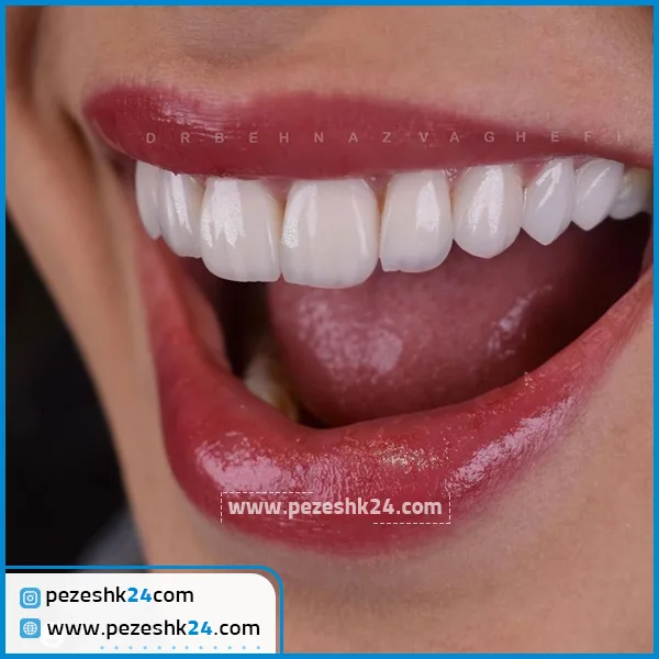 نمونه کامپوزیت دندان دکتر واقفی تهران