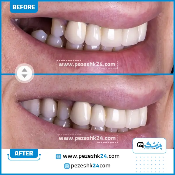 قبل و بعد کامپوزیت ونیر کلینیک رایا