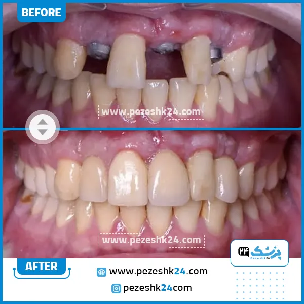 قبل و بعد ایمپلنت دندان کلینیک رایا