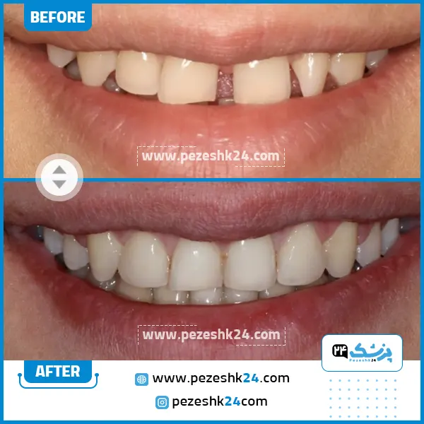 قبل و بعد کامپوزیت کلینیک رایا