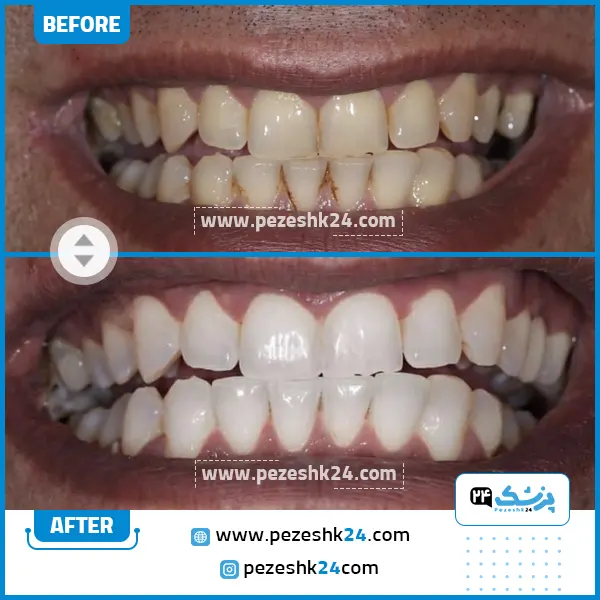قبل و بعد ونیر کامپوزیت کلینیک رایا