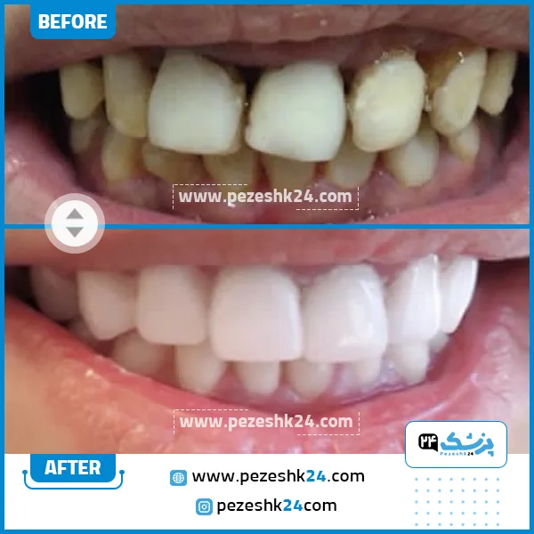 قبل و بعد کامپوزیت دندان کلینیک رومی تهران