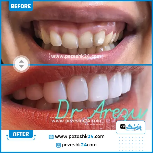 قبل و بعد کامپوزیت دندان کلینیک رومی