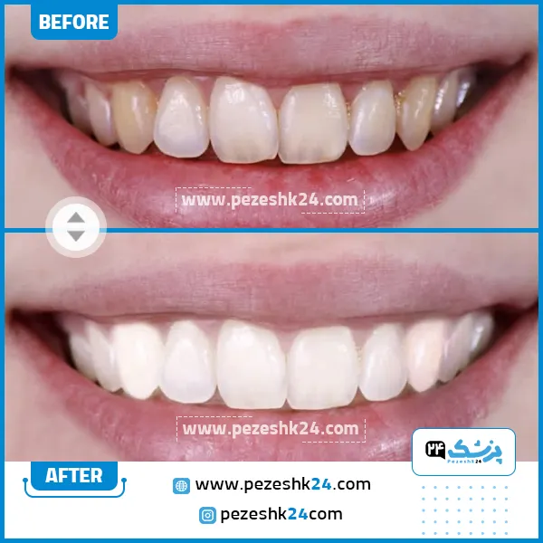 قبل و بعدبلیچینگ دندان در کلینیک رومی