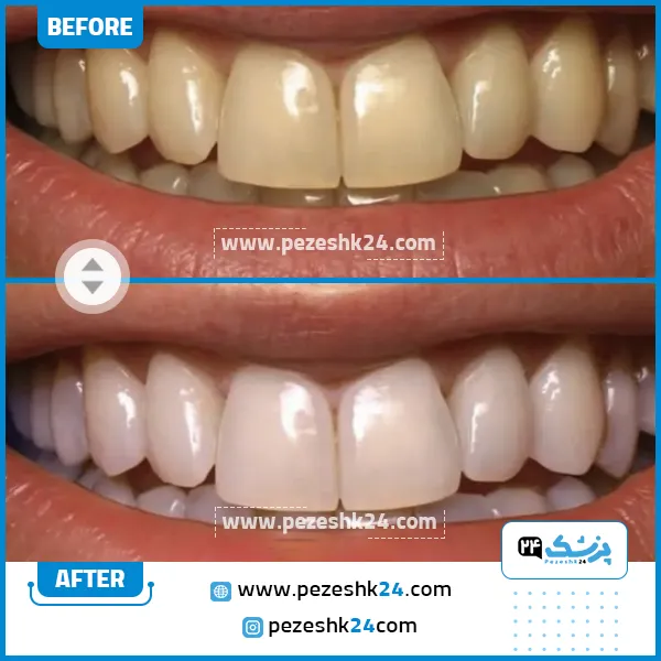 قبل و بعد از سفید کردن دندان کلینیک رومی