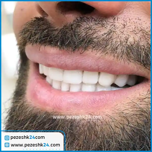 قبل و بعد کامپوزیت دندان دکتر محسن پورحقیقی