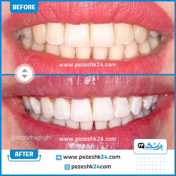 قبل و بعد کامپوزیت دندان دکتر پورحقیقی