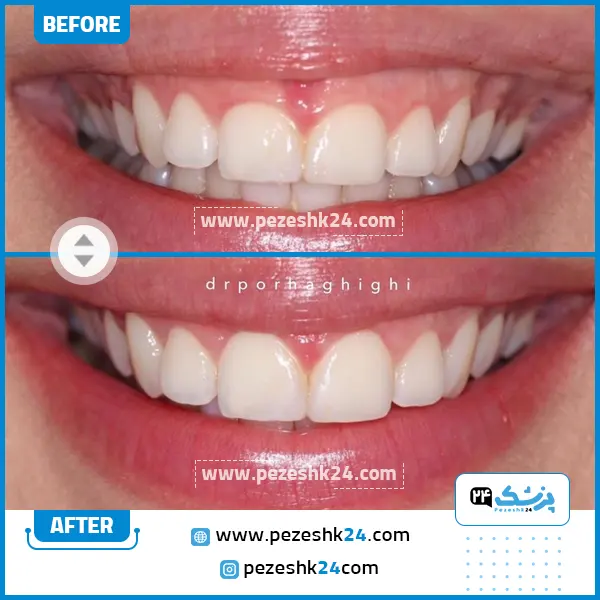قبل و بعد کامپوزیت دندان دکتر پورحقیقی تهران