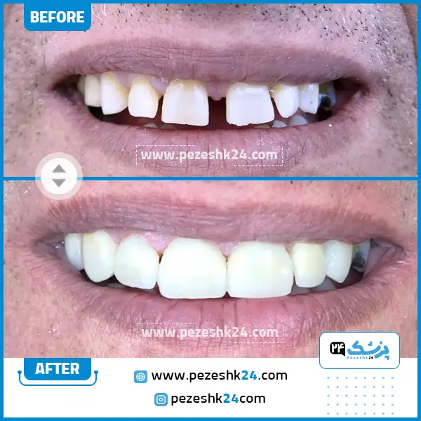 قبل و بعد کامپوزیت دکتر پورحقیقی