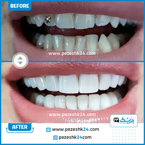 قبل و بعد کامپوزیت ونیر دکتر فرهنگی