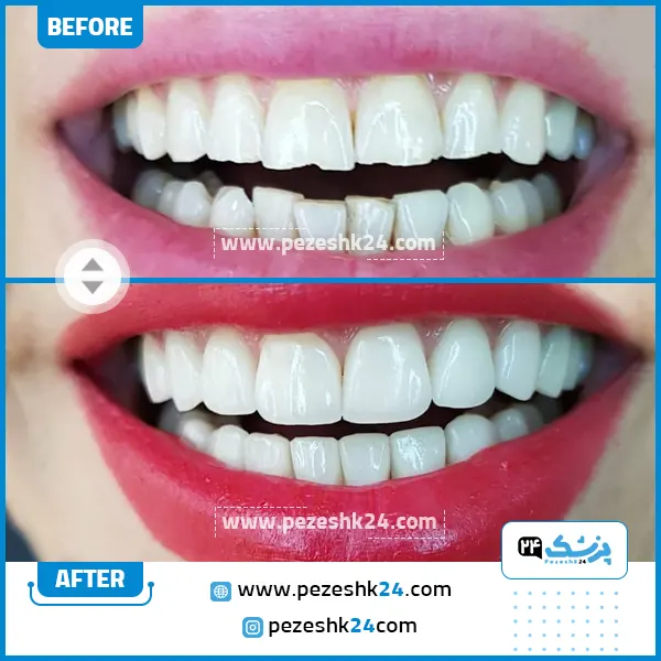 قبل و بعد کامپوزیت دکتر فرهنگی