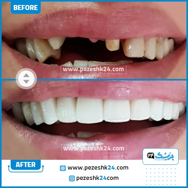 قبل و بعد کامپوزیت ونیر دکتر فرهنگی تهران