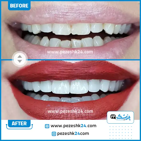 قبل و بعد کامپوزیت دندان دکتر فرهنگی