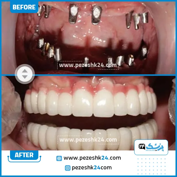 قبل و بعد ایمپلنت دندان کلینیک الماس