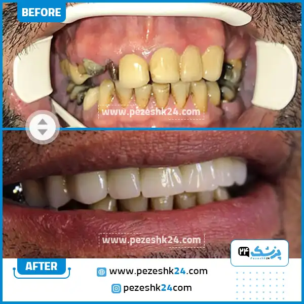 قبل و بعد ایمپلنت کلینیک الماس