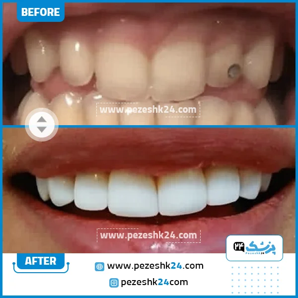 قبل و بعد کامپوزیت ونیر کلینیک سامیا تهران