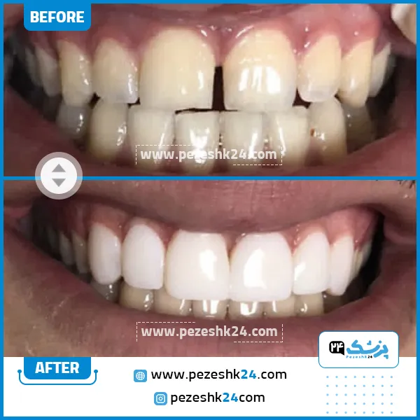 قبل و بعد کامپوزیت کلینیک سامیا تهران