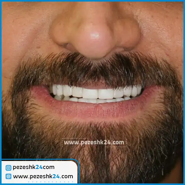 کامپوزیت ونیر دکتر غزال آرش راد