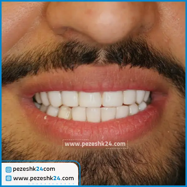 کامپوزیت ونیر دکتر آرش راد