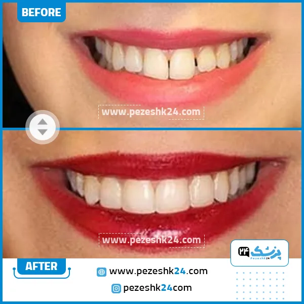 کامپوزیت ونیر دکتر آرش راد تهران