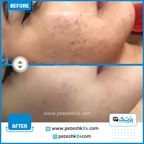 قبل و بعد میکرونیدلینگ صورت