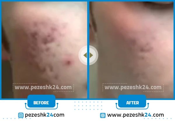 جوانسازی پوست با میکرونیدلینگ