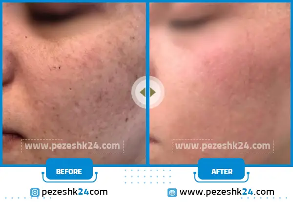 قبل و بعد میکروی صورت