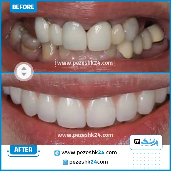 قبل و بعد کامپوزیت دندان کلینیک عاج
