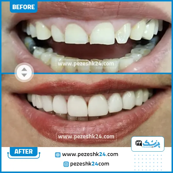 قبل و بعد از ونیر کامپوزیت دندان کلینیک عاج