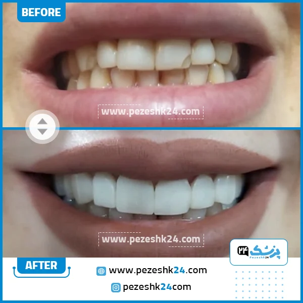 قبل و بعد از ونیر کامپوزیت کلینیک عاج تهران