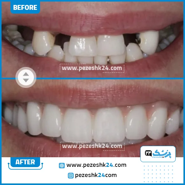 قبل و بعد ایمپلنت دندان کلینیک عاج