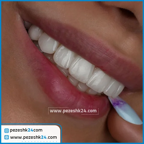 کامپوزیت ونیر دکتر فلاح در تهران