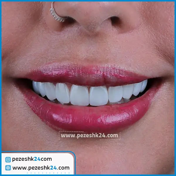 کامپوزیت دندان دکتر فلاح در تهران