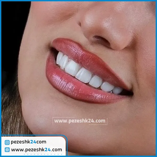 ونیر کامپوزیت دندان دکتر مهرداد فلاح