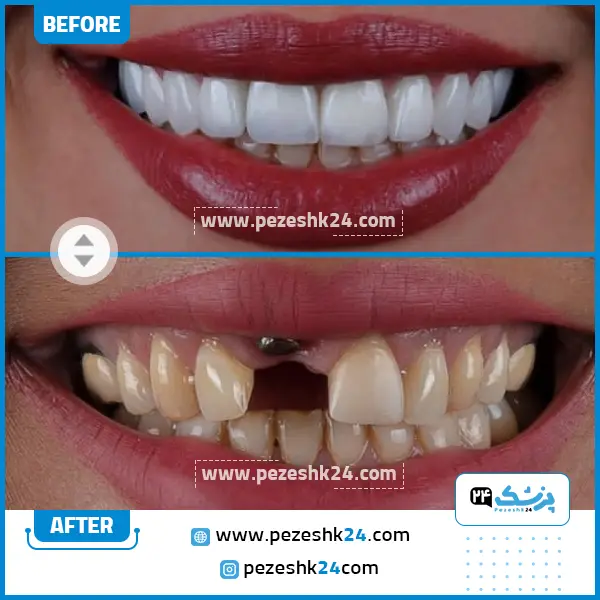 قبل و بعد کامپوزیت دندان دکتر فلاح ت