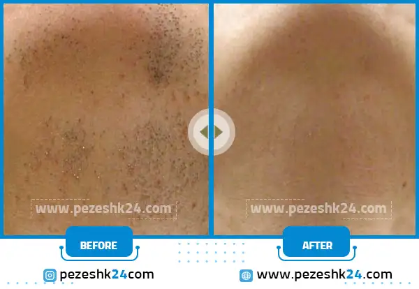 قبل و بعد لیزر موهای زائد کلینیک عرفان