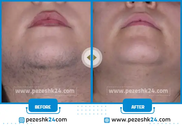 قبل و بعد لیزر موهای زائد کلینیک عرفان