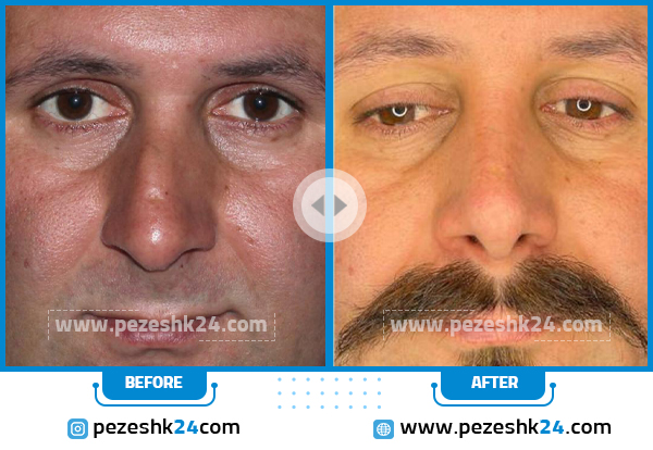 قبل و بعد عمل بینی مردانه دکتر رحیمی پور