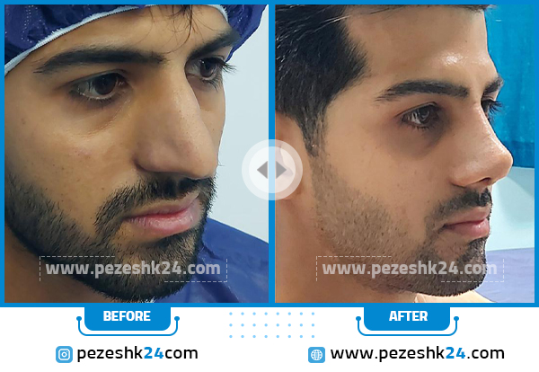 قبل و بعد عمل بینی مردانه دکتر رحیمی پور تهران